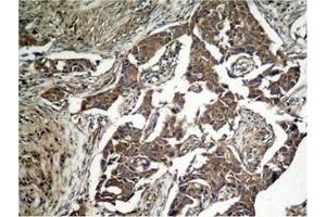 Immunohistochemical analysis of paraffin-embedded human lung carcinoma tissue, using eIF2α (Phospho-Ser51) Antibody. (EIF2S1 antibody  (pSer51))