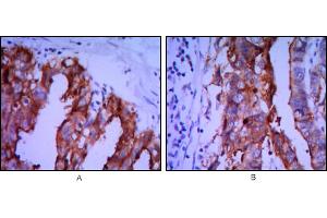 Immunohistochemical analysis of paraffin-embedded ovarian cancer (A), stomach cancer (B) using ALPP mouse mAb with DAB staining. (PLAP antibody)