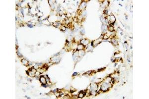 IHC-P: MEK3 antibody testing of human breast cancer tissue (MAP2K3 antibody  (C-Term))