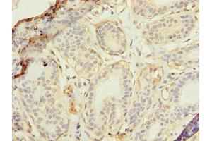 Immunohistochemistry of paraffin-embedded human breast cancer using ABIN7175174 at dilution of 1:100 (RAD23B antibody  (AA 1-250))