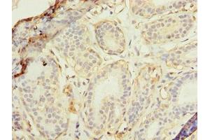 Immunohistochemistry of paraffin-embedded human breast cancer using ABIN7175174 at dilution of 1:100