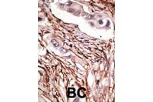 Formalin-fixed and paraffin-embedded human breast cancer tissue reacted with NOTCH3 polyclonal antibody  , which was peroxidase-conjugated to the secondary antibody, followed by DAB staining. (NOTCH3 antibody  (C-Term))