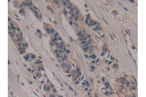Detection of PVR in Human Breast cancer Tissue using Polyclonal Antibody to Poliovirus Receptor (PVR) (Poliovirus Receptor antibody  (AA 56-309))