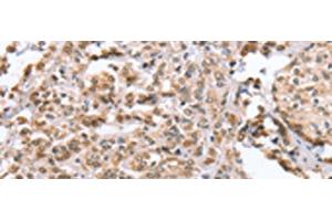 Immunohistochemistry of paraffin-embedded Human prost at e cancer tissue using ZFYVE16 Polyclonal Antibody at dilution of 1:60(x200) (ZFYVE16 antibody)