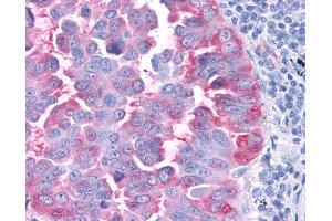 Anti-CCR4 antibody IHC of human Lung, Non-Small Cell Carcinoma. (CCR4 antibody  (C-Term))