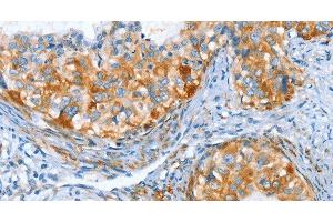 Immunohistochemistry of paraffin-embedded Human cervical cancer tissue using AIP Polyclonal Antibody at dilution 1:80 (AIP antibody)