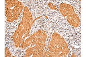 The image on the left is immunohistochemistry of paraffin-embedded Human gastric cancer tissue using ABIN7191067(IKZF4 Antibody) at dilution 1/20, on the right is treated with synthetic peptide. (IKZF4 antibody)