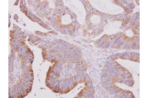 IHC-P Image beta Tubulin 2 antibody [N1C1] detects beta Tubulin 2 protein at cytoplasm on human colon carcinoma by immunohistochemical analysis. (TUBB2A antibody)