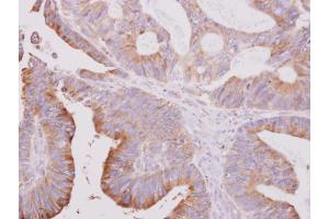 IHC-P Image beta Tubulin 2 antibody [N1C1] detects beta Tubulin 2 protein at cytoplasm on human colon carcinoma by immunohistochemical analysis.