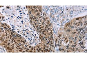 Immunohistochemistry of paraffin-embedded Human esophagus cancer using MAGEA10 Polyclonal Antibody at dilution of 1:30 (MAGEA10 antibody)
