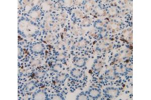 IHC-P analysis of stomach cancer tissue, with DAB staining. (Midkine antibody  (AA 22-143))