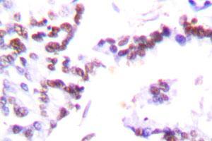 Immunohistochemical analysis of CCNG1 polyclonal antibody  in paraffin-embedded human lung carcinoma tissue.