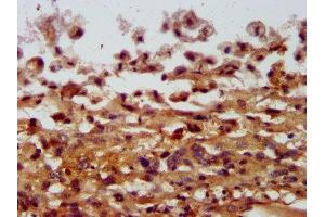 IHC image of ABIN7148018 diluted at 1:400 and staining in paraffin-embedded human melanoma performed on a Leica BondTM system. (COPG2 antibody  (AA 676-823))