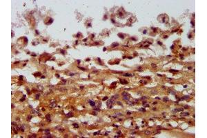IHC image of ABIN7148018 diluted at 1:400 and staining in paraffin-embedded human melanoma performed on a Leica BondTM system. (COPG2 antibody  (AA 676-823))