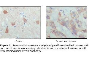 Immunohistochemical analysis of paraffin-embedded human brain (left) and breast carcinoma (right), showing cytoplasmic and membrane localization using PAR4 antibody with DAB staining. (F2RL3 antibody  (AA 1-330))