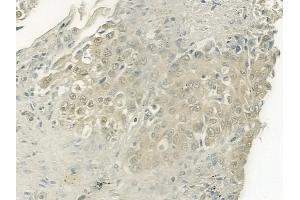 ABIN6264131 and ABIN6277486 at 1/100 staining human lung squamous cell carcinoma by IHC-P.