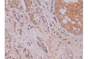 Detection of β-catenin in Human Breast cancer Tissue using Monoclonal Antibody to Beta Catenin (β-catenin) (beta Catenin antibody  (AA 439-675))