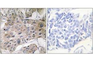 Immunohistochemistry analysis of paraffin-embedded human breast carcinoma tissue, using COX7S/A2 Antibody. (COX7S/A2 (AA 1-50) antibody)