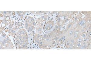 Immunohistochemistry of paraffin-embedded Human esophagus cancer tissue using USO1 Polyclonal Antibody at dilution of 1:30(x200) (USO1 antibody)