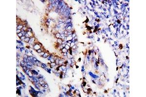 IHC-P: Bcl-XS antibody testing of human colon cancer tissue (Bcl-X/s (AA 120-130) antibody)