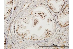 Immunoperoxidase of monoclonal antibody to LMO4 on formalin-fixed paraffin-embedded human prostate.