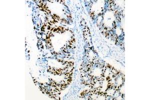 Immunohistochemical analysis of CDK2 staining in human colon cancer formalin fixed paraffin embedded tissue section.