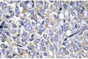 Immunohistochemistry analysis of Cortactin antibody in paraffin-embedded human prostate carcinoma tissue. (Cortactin antibody  (pTyr421))