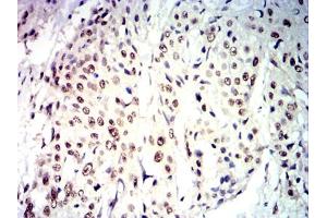 Immunohistochemical analysis of paraffin-embedded esophageal cancer tissues using CDX2 mouse mAb with DAB staining.