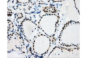 Immunohistochemical staining of paraffin-embedded Adenocarcinoma of colon tissue using anti-RALBP1mouse monoclonal antibody.