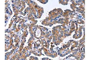 The image on the left is immunohistochemistry of paraffin-embedded Human thyroid cancer tissue using ABIN7129821(IGSF10 Antibody) at dilution 1/50, on the right is treated with fusion protein.