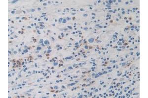 DAB staining on IHC-P; Samples: Human Stomach cancer Tissue (Dopamine Receptor d1 antibody  (AA 338-446))