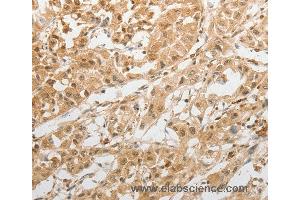 Immunohistochemistry of Human lung cancer using GRIN2C Polyclonal Antibody at dilution of 1:100 (GRIN2C antibody)