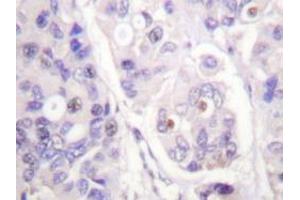 Immunohistochemical analysis of human breast carcinoma tissue (Formalin- fixed Paraffin-embedded) using CDC16 / APC6 antibody . (CDC16 antibody)