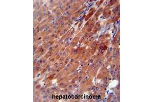 CES2 antibody (Center) immunohistochemistry analysis in formalin fixed and paraffin embedded human hepatocarcinoma followed by peroxidase conjugation of the secondary antibody and DAB staining.