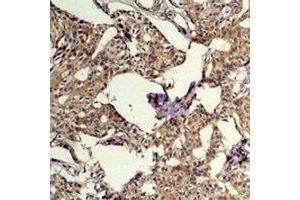 Immunohistochemical analysis of c-FOS staining in human breast cancer formalin fixed paraffin embedded tissue section. (c-FOS antibody)