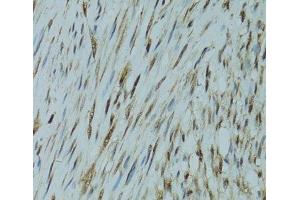 Immunohistochemistry of paraffin-embedded Human uterine cancer using GABPA Polyclonal Antibody at dilution of 1:100 (40x lens). (GABPA antibody)