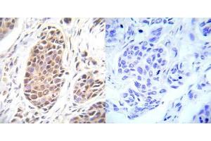 Immunohistochemical analysis of paraffin- embedded human breast carcinoma tissue using FOXO3A (Ab-253) antibody (E022020). (FOXO3 antibody)
