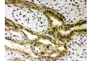 Anti-SIRT6Picoband antibody, (ABIN3043435), IHC(P)IHC(P): Human Mammary Cancer Tissue (SIRT6 antibody  (AA 14-180))