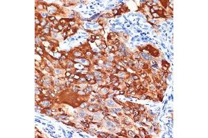 Immunohistochemistry of paraffin-embedded human lung cancer using IL13R Rabbit mAb (ABIN7267986) at dilution of 1:100 (40x lens). (IL13 Receptor alpha 1 antibody)