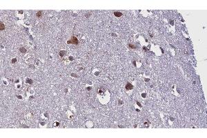 ABIN6275839 at 1/100 staining Human brain cancer tissue by IHC-P. (MATK antibody  (Internal Region))