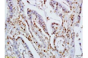 Formalin-fixed and paraffin embedded human colon carcinoma labeled with Rabbit Anti KLF4 Polyclonal Antibody, Unconjugated  at 1:200 followed by conjugation to the secondary antibody and DAB staining (KLF2/4 antibody  (AA 415-513))