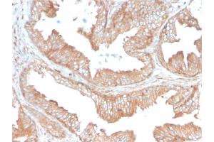 Formalin-fixed, paraffin-embedded human Prostate Carcinoma stained with CD47 Mouse Monoclonal Antibody (IAP/3019). (CD47 antibody  (AA 18-135))