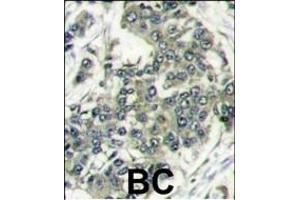 Formalin-fixed and paraffin-embedded human breast carcinoma reacted with EIF4E antibody (N-term) (ABIN388675 and ABIN2838633) , which was peroxidase-conjugated to the secondary antibody, followed by DAB staining. (EIF4E antibody  (N-Term))