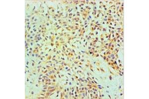 Immunohistochemical of paraffin-embedded Human Breast tissue using ABIN7144345 at dilution of 1:200. (Annexin A2 antibody)