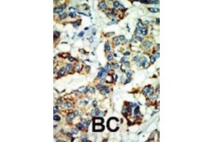 Formalin-fixed and paraffin-embedded human cancer tissue reacted with the primary antibody, which was peroxidase-conjugated to the secondary antibody, followed by AEC staining. (NEK4 antibody  (C-Term))