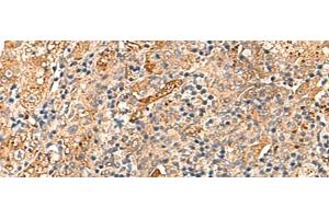 Immunohistochemistry of paraffin-embedded Human liver cancer tissue using DNAJC14 Polyclonal Antibody at dilution of 1:70(x200) (DNAJC14 antibody)