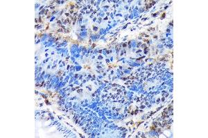 Immunohistochemistry of paraffin-embedded human colon carcinoma using CTIP1/BCL11A Rabbit mAb  at dilution of 1:100 (40x lens). (BCL11A antibody)