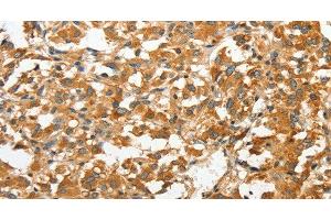 Immunohistochemistry of paraffin-embedded Human thyroid cancer tissue using ANXA9 Polyclonal Antibody at dilution 1:30 (Annexin A9 antibody)