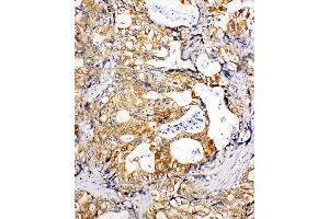 Anti-SDHC antibody, IHC(P) IHC(P): Human Gastric Cancer Tissue (SDHC antibody  (N-Term))