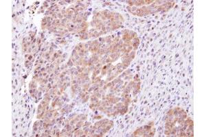 IHC-P Image Immunohistochemical analysis of paraffin-embedded NCIN87 xenograft, using CHMP5, antibody at 1:100 dilution. (CHMP5 antibody)